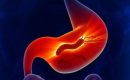 幽門螺旋桿菌可致胃癌？你是否無症狀帶菌者？