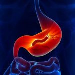 幽門螺旋桿菌可致胃癌？你是否無症狀帶菌者？