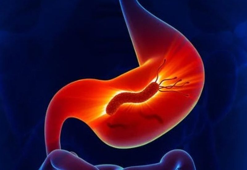 幽門螺旋桿菌可致胃癌？你是否無症狀帶菌者？