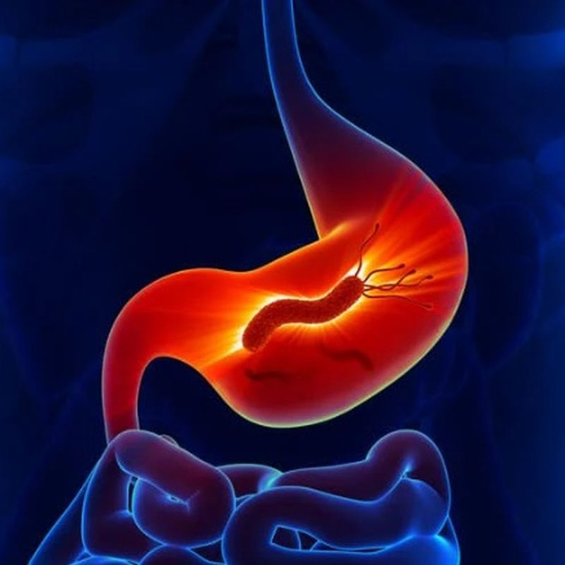 幽門螺旋桿菌可致胃癌？你是否無症狀帶菌者？