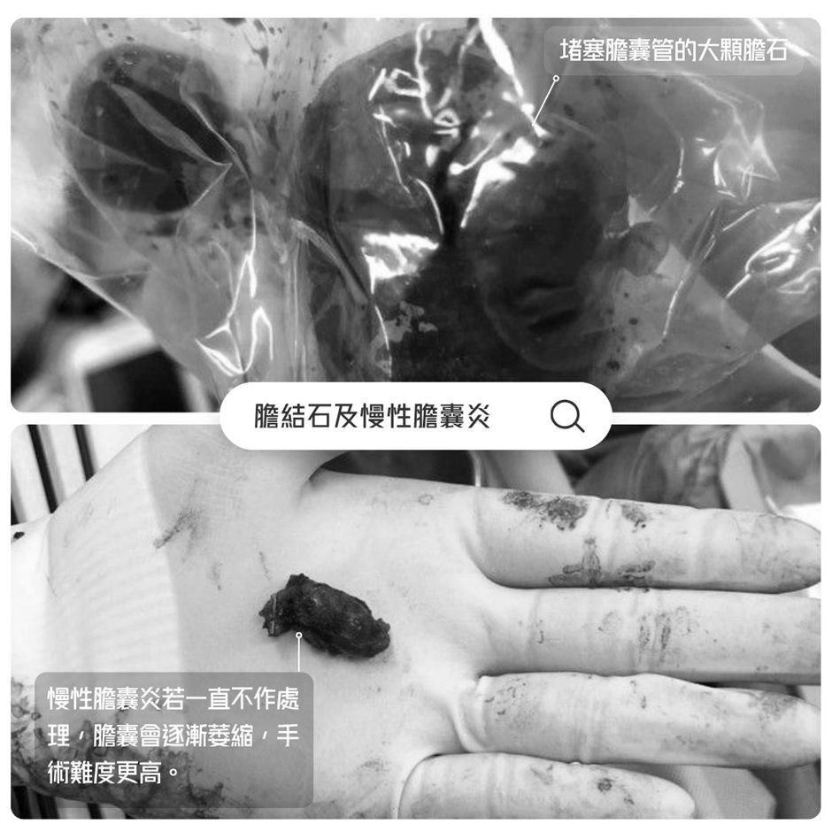 身體檢查發現「無症狀膽結石」需要開刀嗎？醫生剖析手術的真正時機