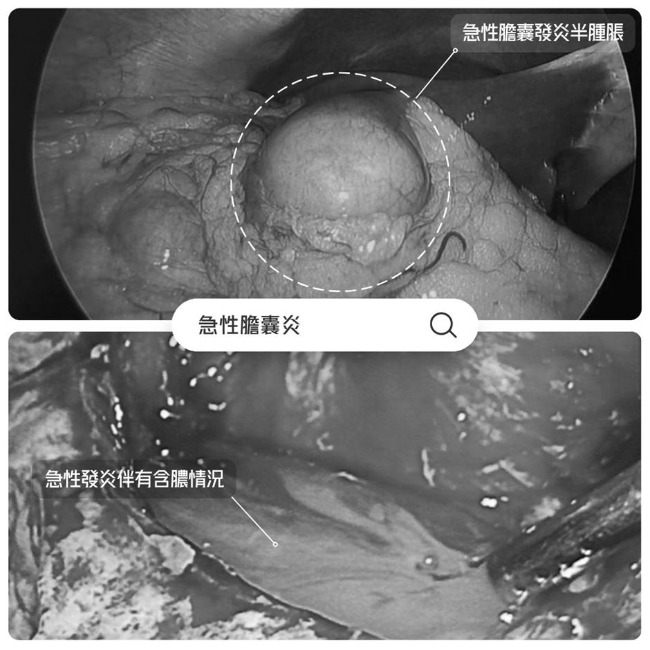 右上腹劇痛要當心急性膽囊炎！延誤治療可能引發敗血症等嚴重併發