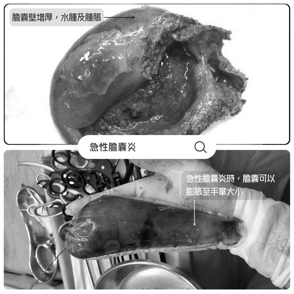 右上腹劇痛要當心急性膽囊炎！延誤治療可能引發敗血症等嚴重併發